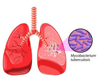  Estrategias para el control de la tuberculosis